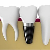 hienimplantdl