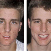 Naturaltreatmentofacneformen